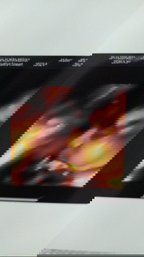 Kehamilan 30 Minggu, baru terdeteksi miom