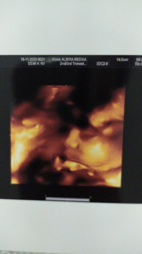 Kehamilan 30 Minggu, baru terdeteksi miom