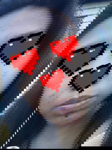 Pimples attacks 😭