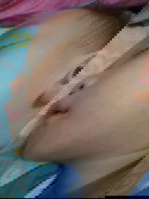 Bruntusan di anak 21 bln bidur ? Gabag ?