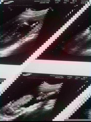 ท้องแรก♥️👶