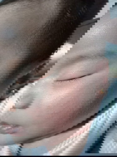 Rashes sa face...