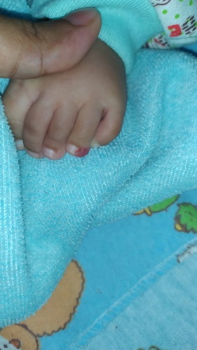 Warna merah pada kaki