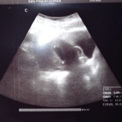 USG 7 weeks