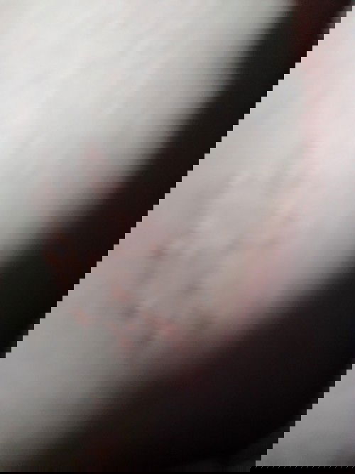 Ruam pada kulit ibu hamil