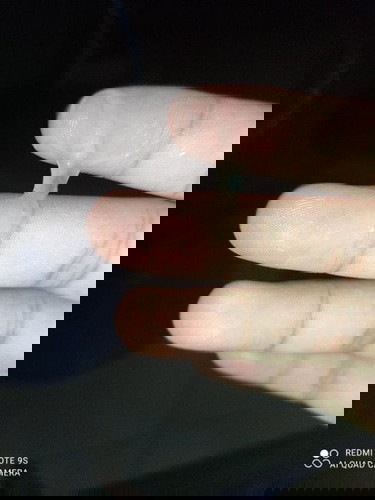 ครรภ์37w6d