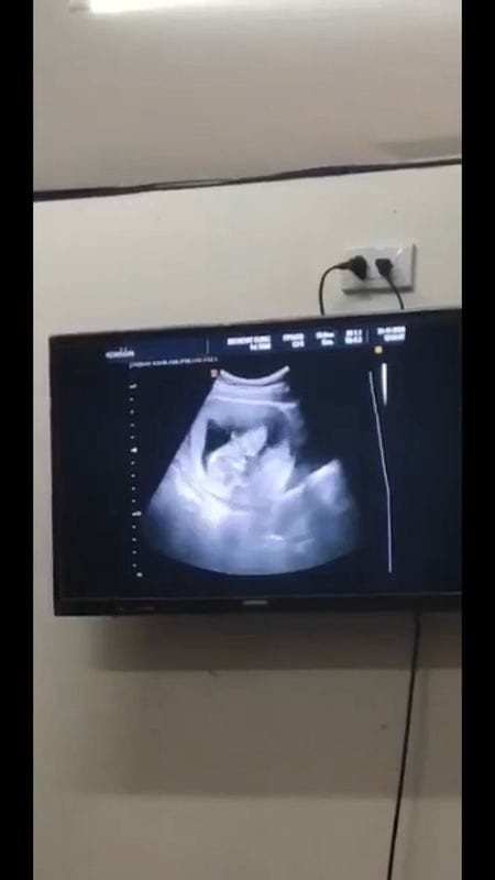 จะหญิงหรือชายน๊า บ้านอื่นรู้เพศน้องกันกี่วีคคะ และน้องดิ้นจะรู้สึกตอนกีวีคขึ้นไปจ้า