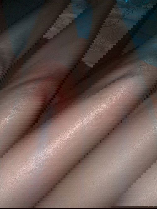 Bun mau tanya selama kehamilan ada yg mengalami gatal2 di kaki&tgn? obatnya apa ya?