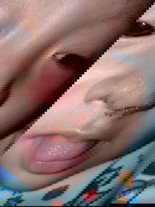 Sekitar hidung melepuh