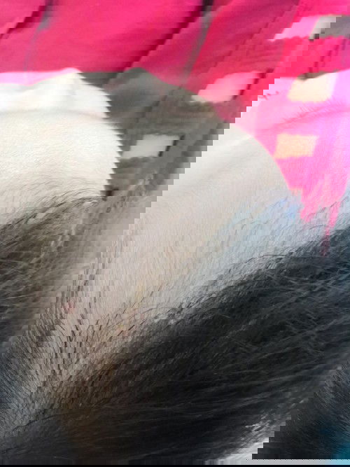 Đầu bé bị nổi giống như sẩy? Bên trong có mũ!!