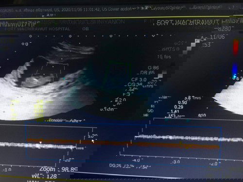 คุณแม่ท่านไหนพอจะรู้ไหมว่าใช่ตัวเด้กหรือว่าถุงลมค่ะ