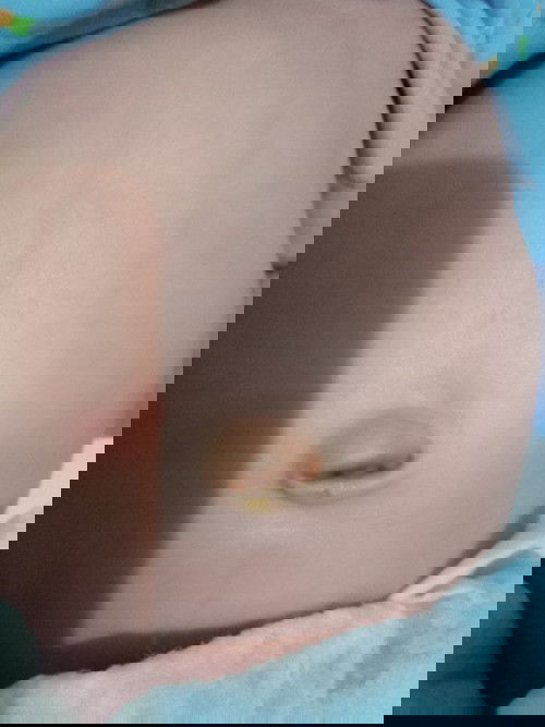 Pusar bayi masih belum kering setelah puput