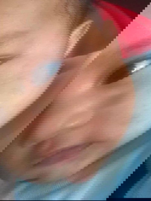 Muka gatal dan berbiji merah