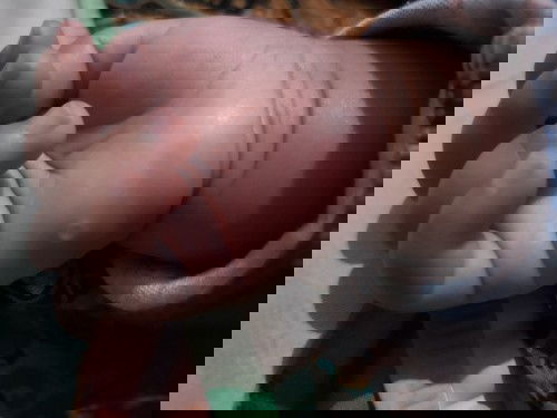 Digigit serangga atau nyamuk