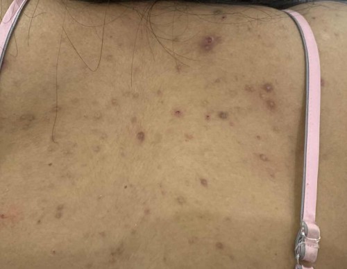 Ada yang sama ga, semenjak hamil punggung sama dada ada jerawat banyak