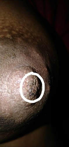 something on my nipple