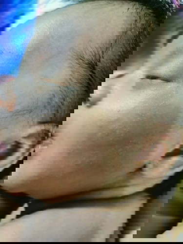 Butlig sa mukha ni baby