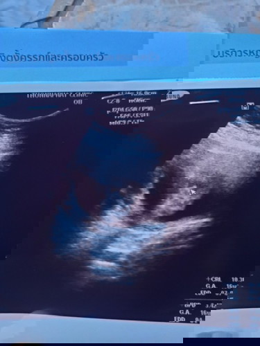 แบบนี้คือ ช แน่นอนมั้ยคะ
เห็นหมอบอกว่าเป็นกระจู๋น้อยๆ555
ใครมีประสบการณ์ แชร์รูปให้ดูบ้างนะคะ