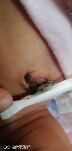 18 days n po ung pusod nya.. Hndi pdn po natatanggal.. Unang week betadine po gnamit ko tpos pinalt.