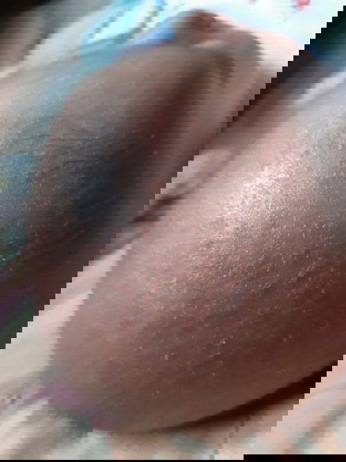 Bintik Merah dikepala