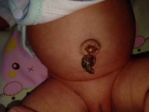 สะดือปกติไหมค่ะ