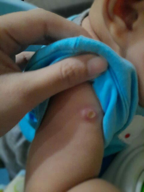 Bun, knp ya bekas suntikan imunisasi pertama jd pecah bolong bernanah gini? Padahal gk diapa2in
