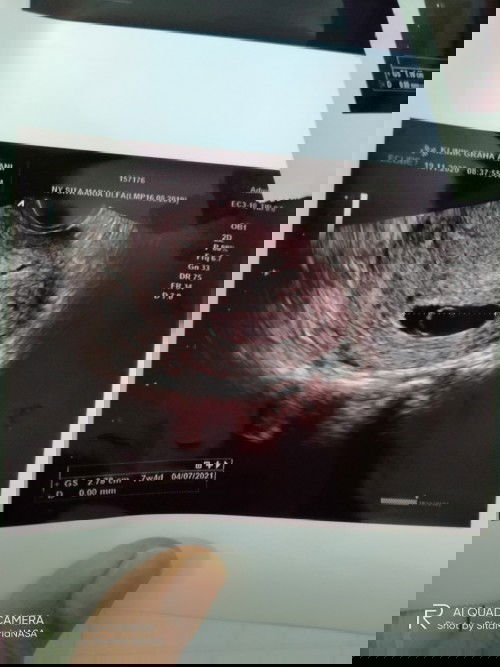 7w4d janin belum ada