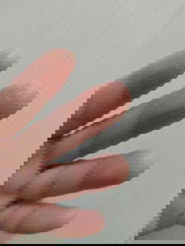 Eczema ba to or mas malala pa?