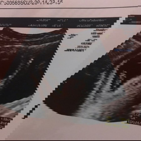 เด็กหัวใจไม่เต้น