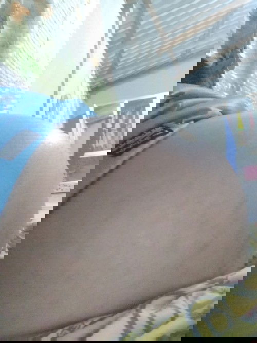 ท้องเริ่มแตกลายตอน 34 week