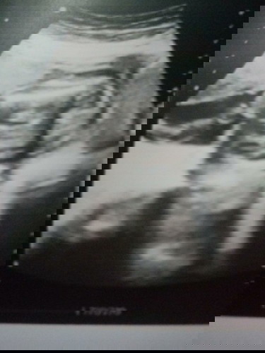 Boy or girl po? Parang me nkalawit dw but then d p rn dw sure c ob. Thanks po