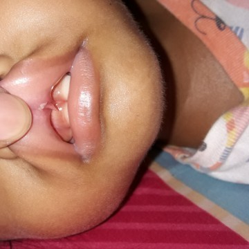 Gusi atas anak robek
