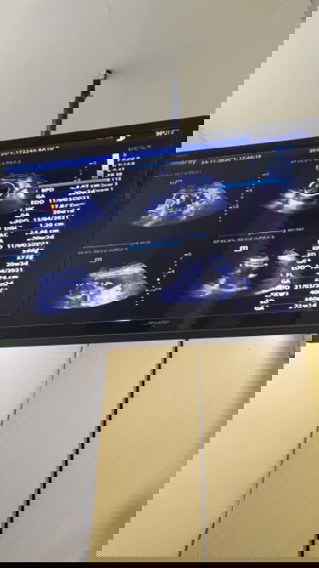 kandungan kelilit, air ketuban keruh dan ada penebalan di otak janin