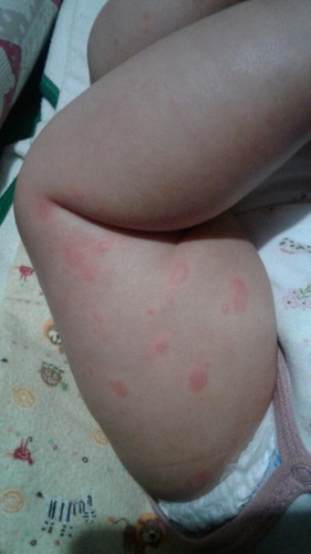 Skin rashes..😢