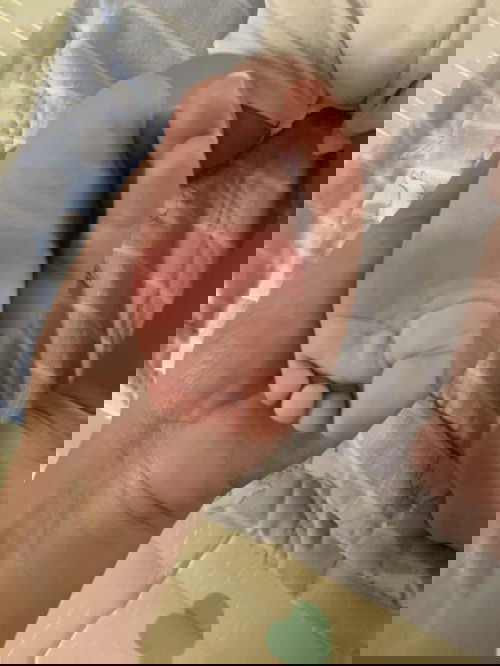 เท้าลูกมีรอยแดง