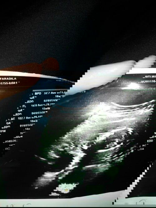 Assalamualaikum. Ibu ibu blh ka pinjam mata ibu ibu yang pernah scan baby twins klw mcm ni twins ka?
