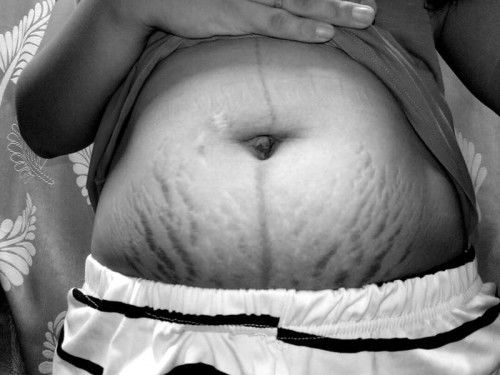 I USED to be so scared of having stretchmarks.