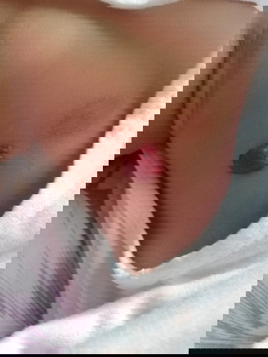 Birthmark