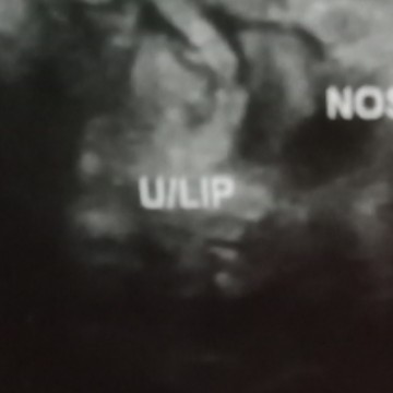 U/LIP Pelvic Ultrasound