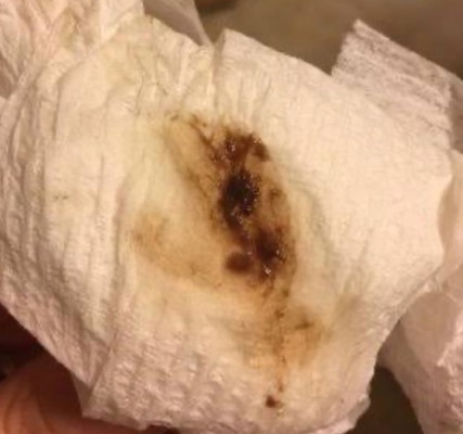 Dark Brown Discharge