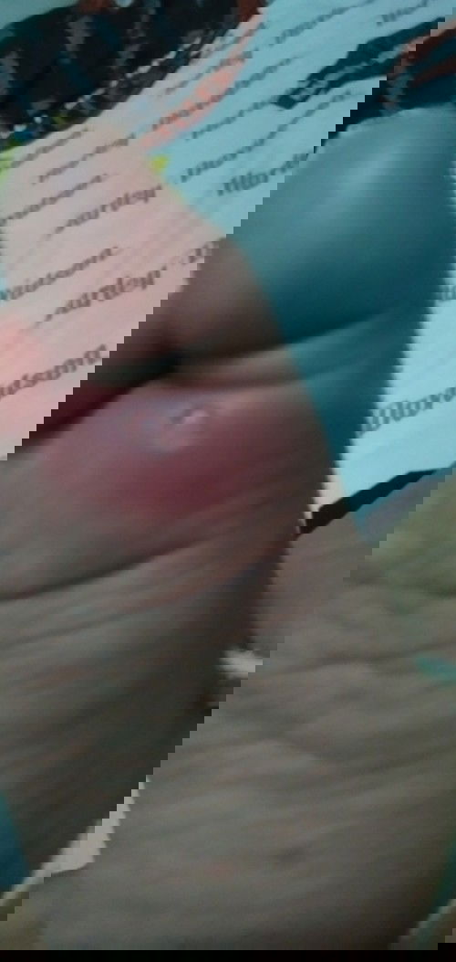 muncul luka pada kaki