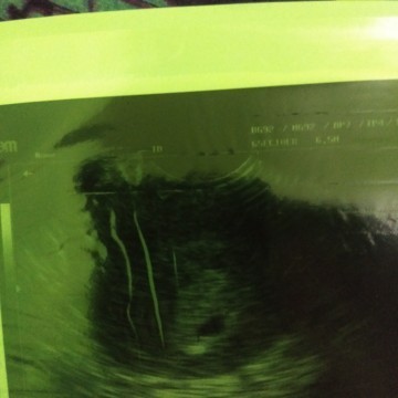 Hitungan kandungan  dokter berbeda dengan HPHT