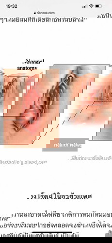 ต่อมบาร์โธลินอักเสบ ตอนตั้งครรภ์‼️‼️