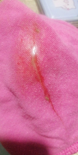 Dicharge (from red to sticky brown)