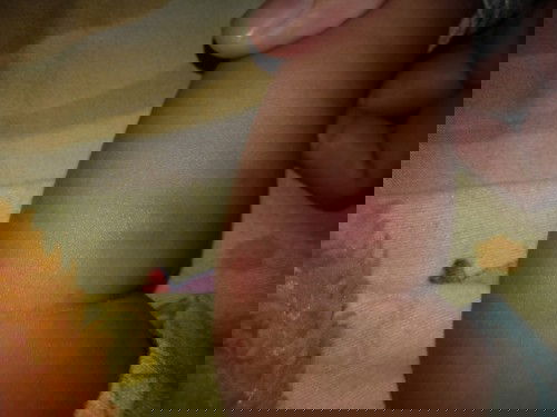 Obat untuk gigitan serangga