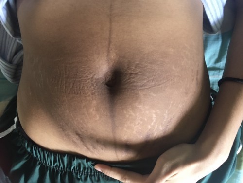 ยับมากเลยค่ะ ลูกคนเเรกยังมีโอกาสกลับไปเหมือนเดิมไหมคะ