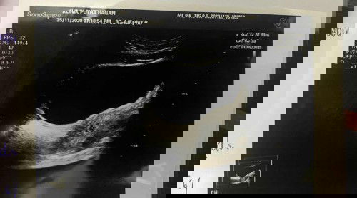 Repeat scan lagi 2minggu. Hanya nampak kantung saja