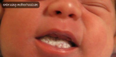 Thrush sa dila ni baby