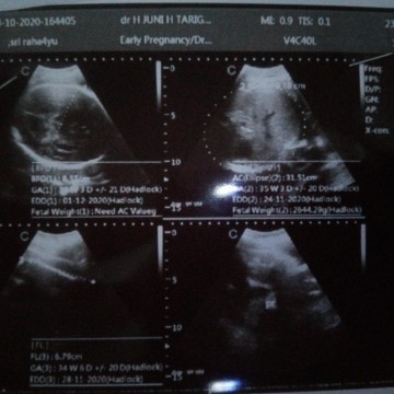 Kenapa udah 39 minggu lewat 5 hari belum ada tanda tanya mau lahiran yaπ
Jadi takut