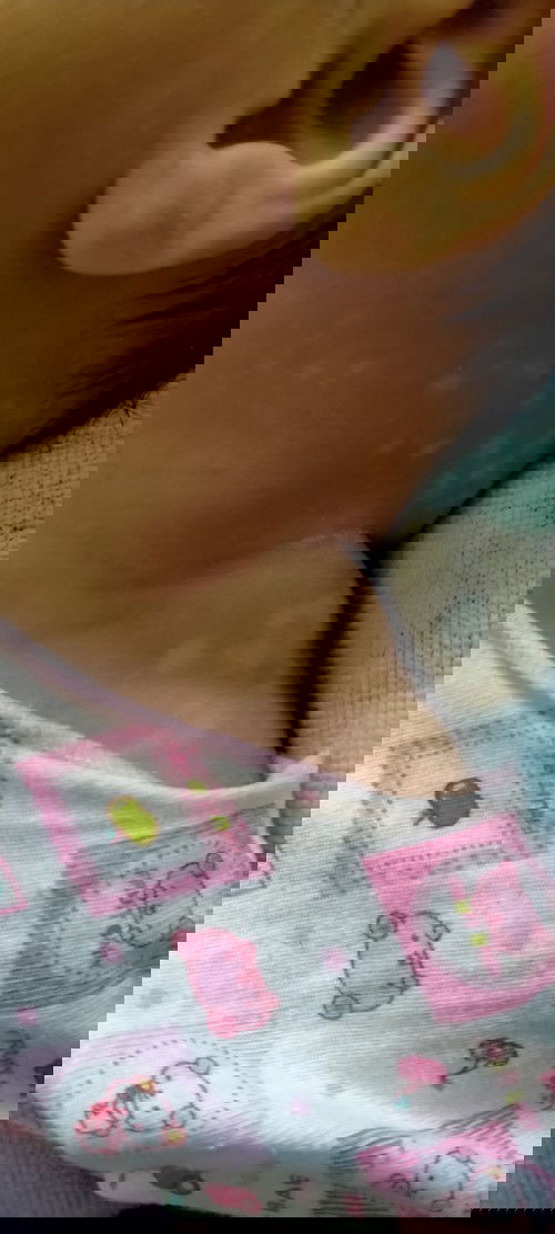 น้องเป็นจุดด่างดำที่คอ